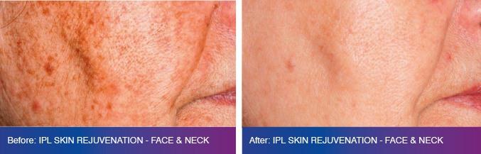 IPL Treatments at City Retreat Spas Salons In Jesmond