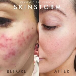Skinstorm Facials in Newcastle