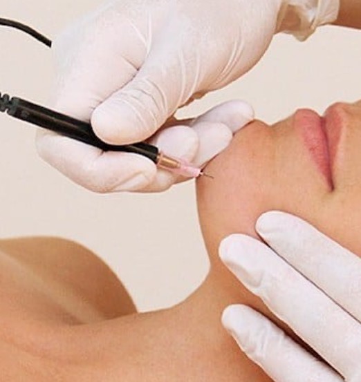 electrolysis hair removal city retreat beauty salons newcastle